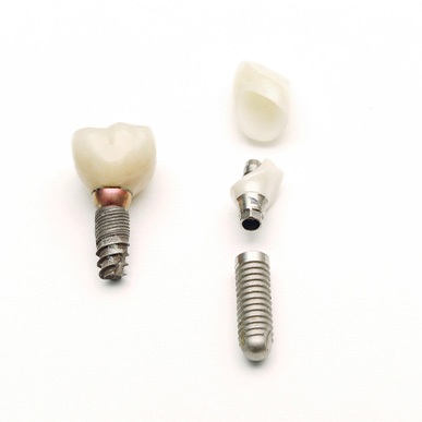 dental implant parts