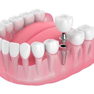 Illustration of a single dental implant
