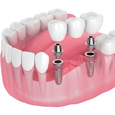 Illustration of an implant bridge