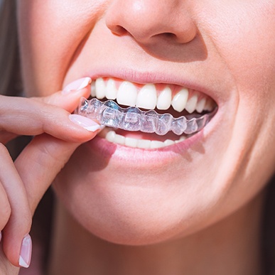 Woman putting in Invisalign clear aligners