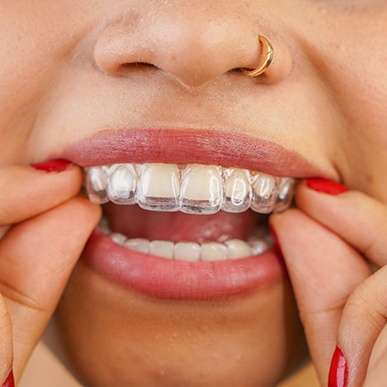 Woman putting in Invisalign aligners