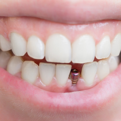 Closeup of a dental implant