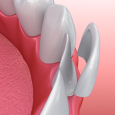 Illustration of veneer being placed on a tooth 