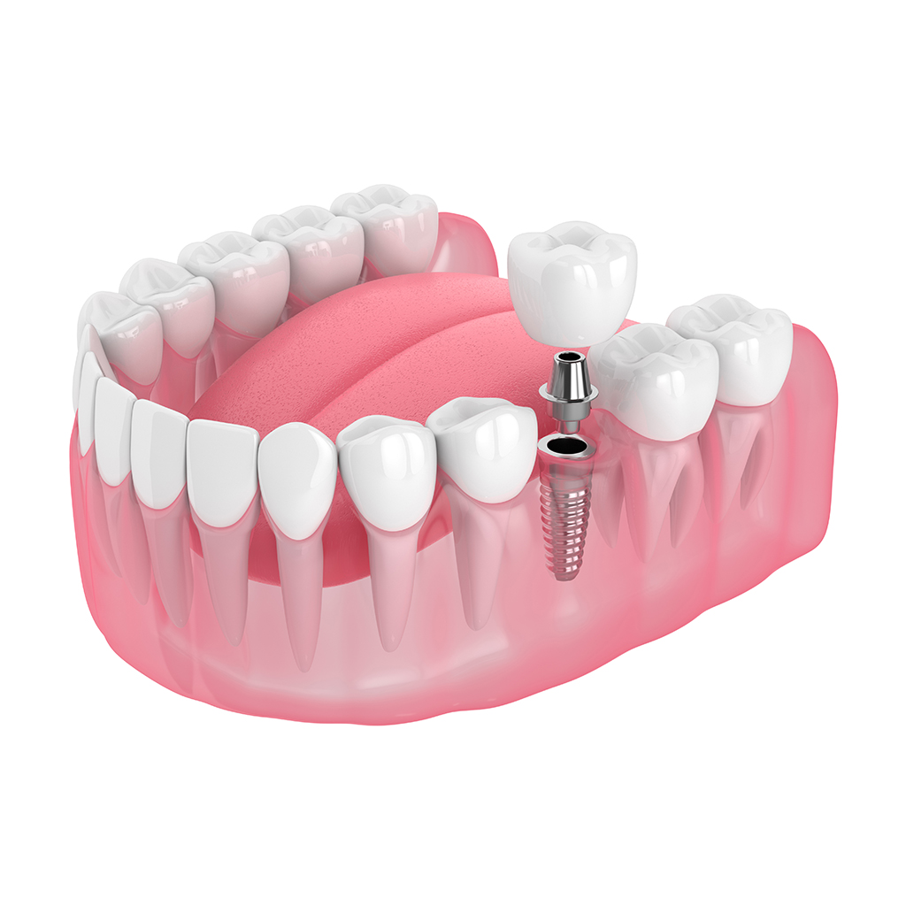 Dental Implant Restoration