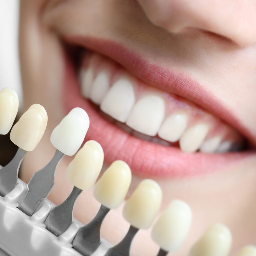 Teeth Whitening