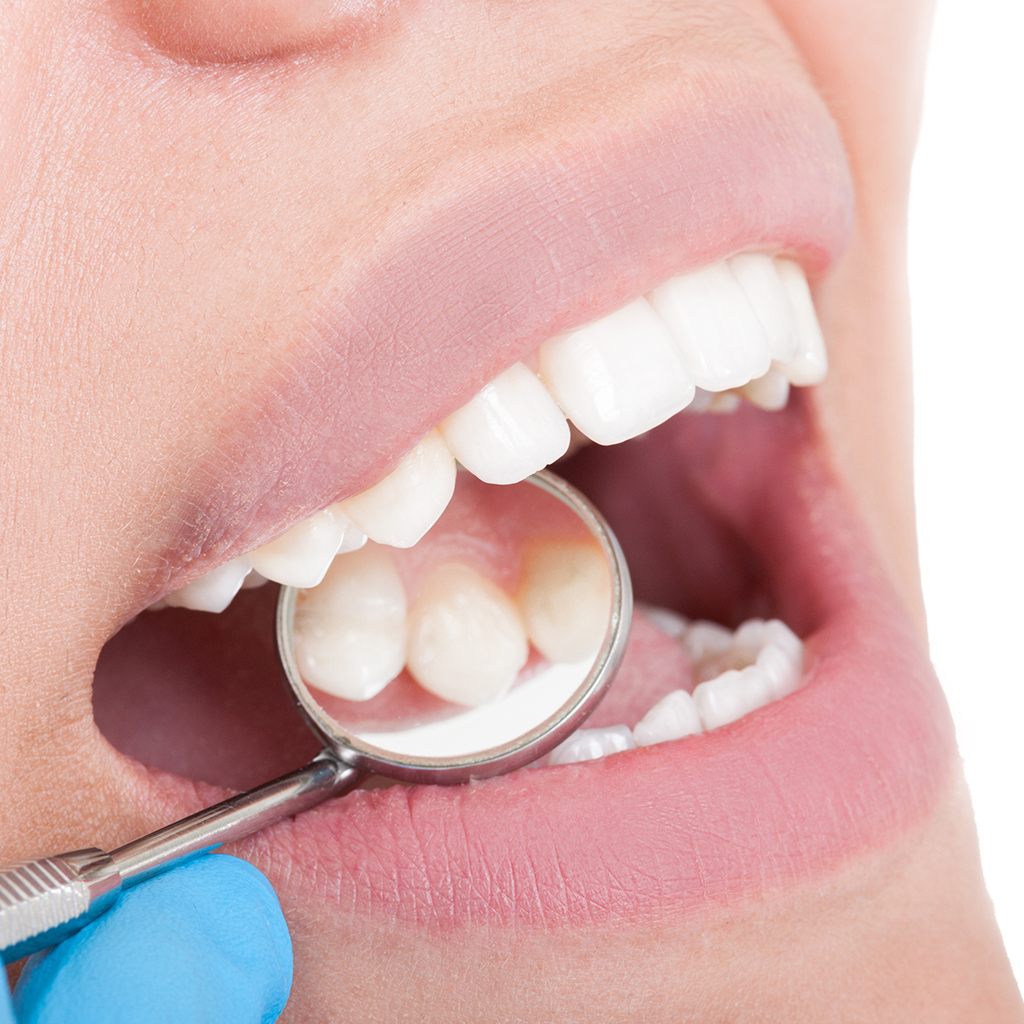 Tooth Colored Fillings